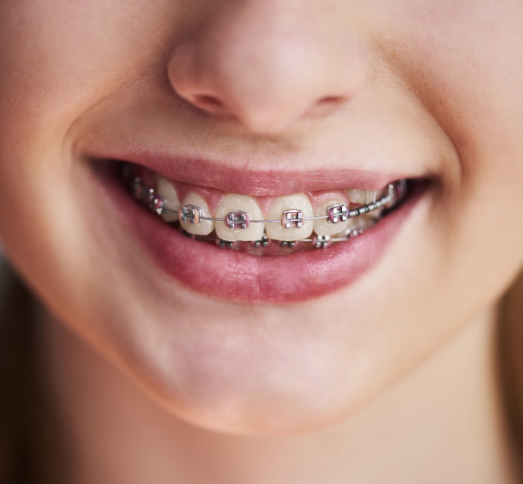 Close-up of smiling person displaying metal braces on upper and lower teeth.